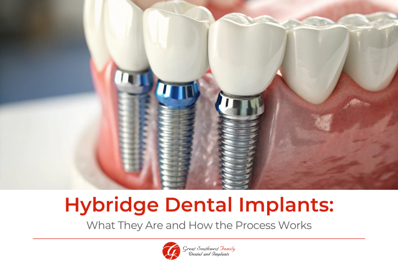 Hybridge Dental Implants What They Are and How the Process Works