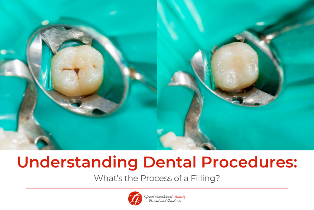 Understanding Dental Procedures What’s the Process of a Filling